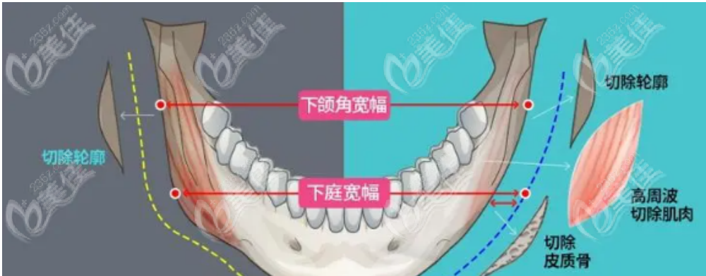 磨骨手术示意图