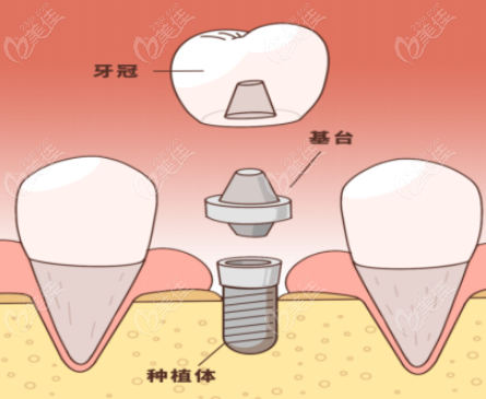 北京中诺口腔医院种牙价格表 北京中诺口腔医院种牙价格表