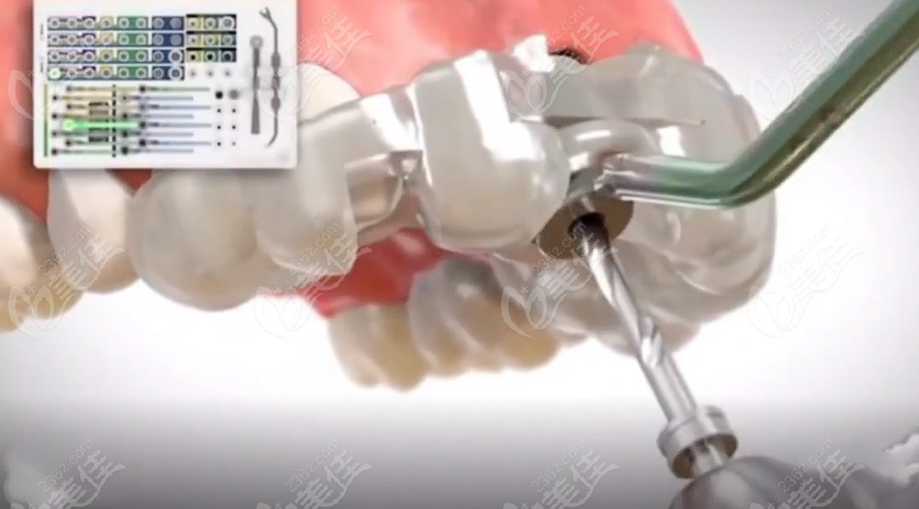 3D数字化种植牙与普通种植牙