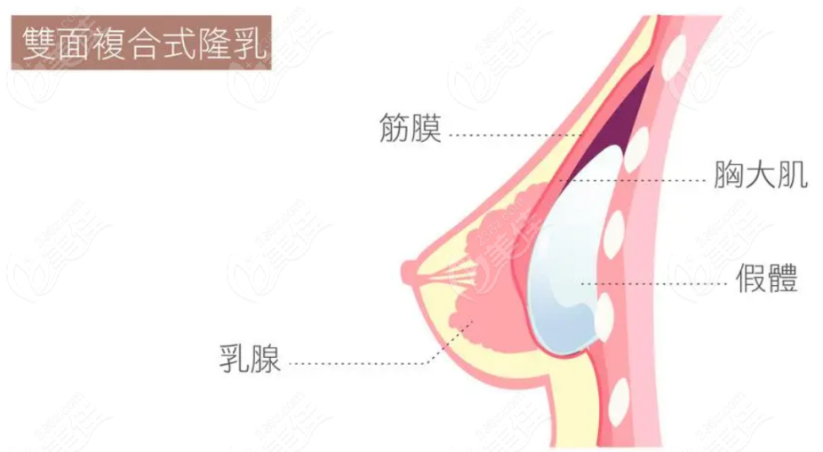 假体隆胸手术示意图