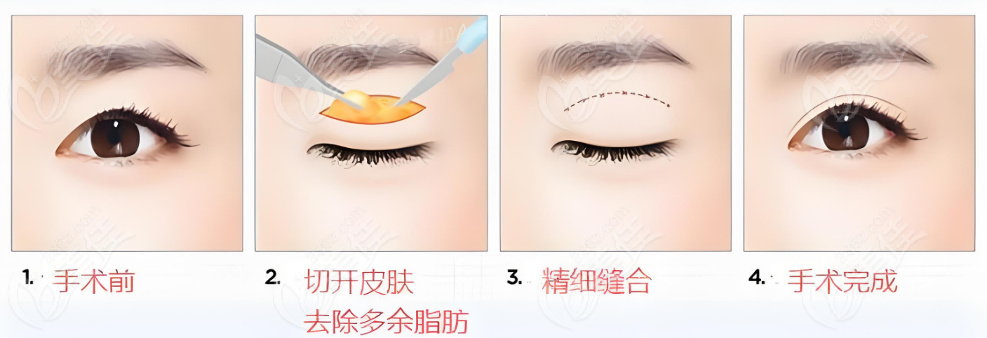 上海杨亚益做双眼皮修复技术可信