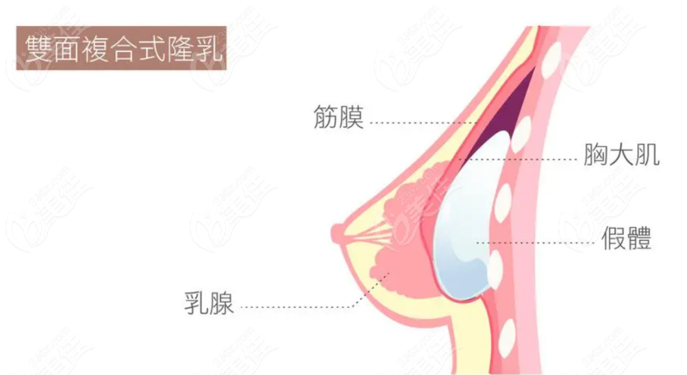 复合隆胸