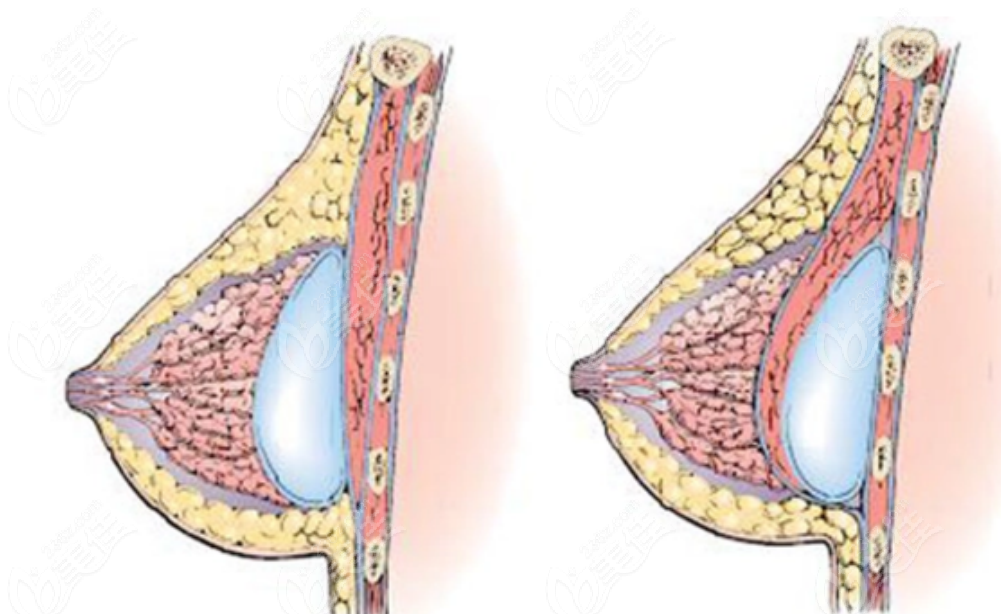 假体隆胸手术示意图