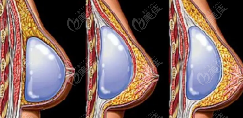 236z.com假体隆胸手术示意图