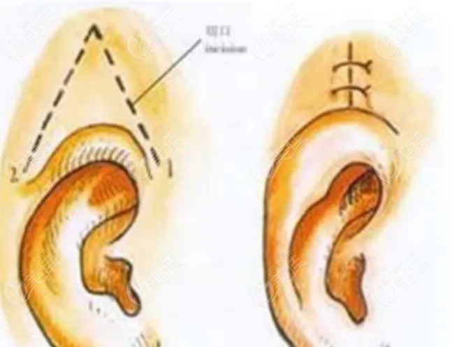 耳再造手术示意图