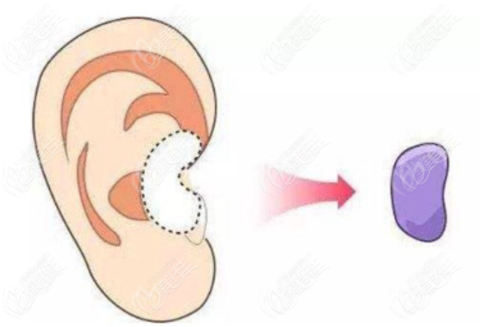 耳再造手术示意图