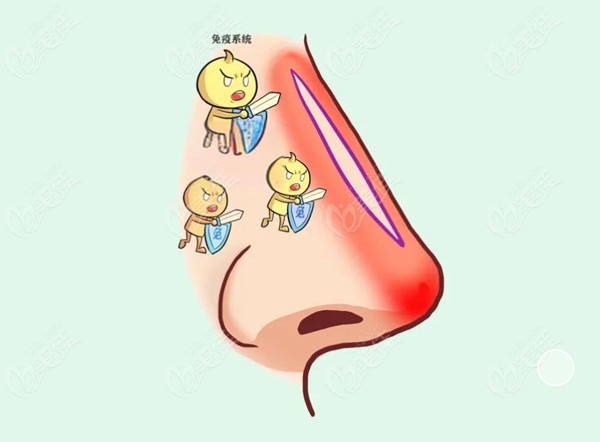 郑州东方整形医院李冰医生做鼻子优势