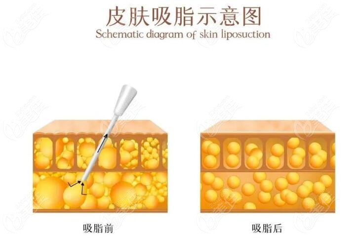 郑州刘乾坤吸脂好