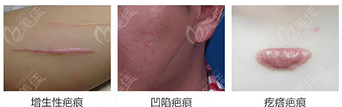 武晓莉做疤痕手术好