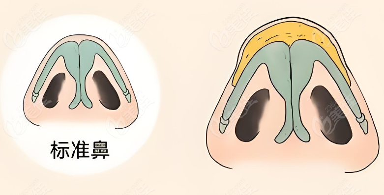 范荣杰鼻部整形预约挂号注意事项www.236z.com