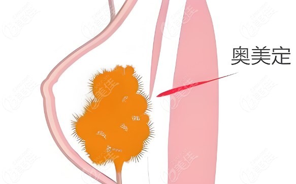 奥美定取出