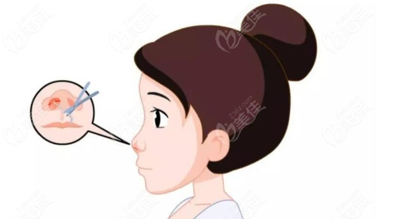 各种鼻部手术经历236z.com