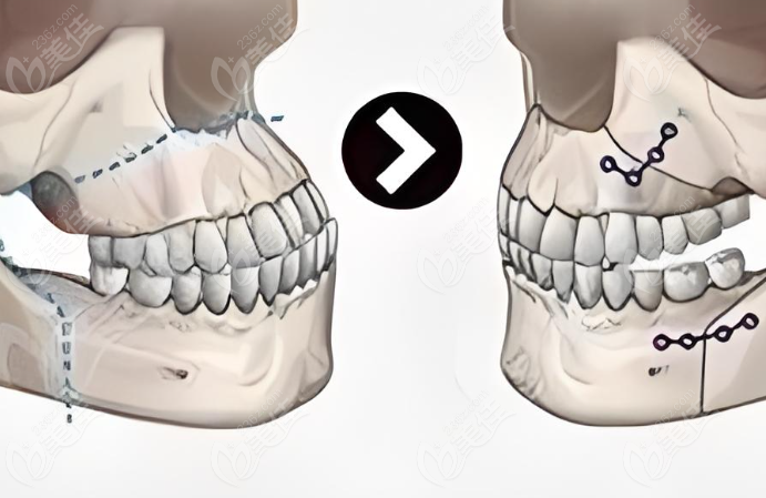 牙槽骨截骨内推的手术