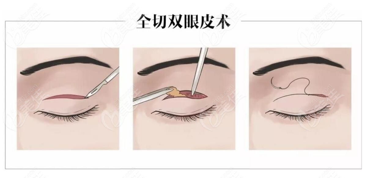 全切双眼皮技术手术