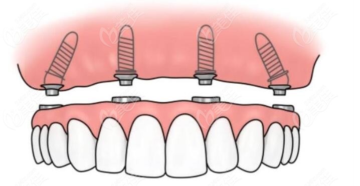 南昌即刻種植牙口腔醫(yī)院排名前十優(yōu)勢介紹