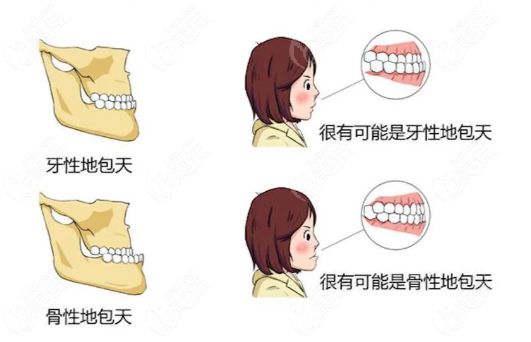 牙性与骨性地包天的区别