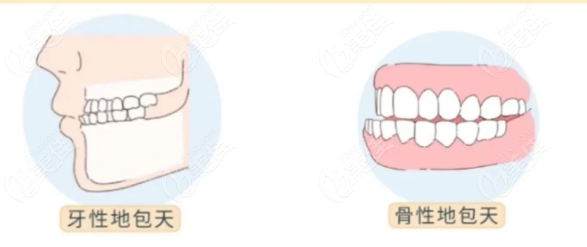 牙性和骨性地包天矫正