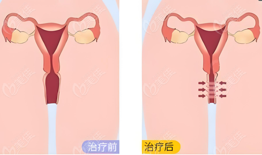3D生物束带紧缩术的作用机制