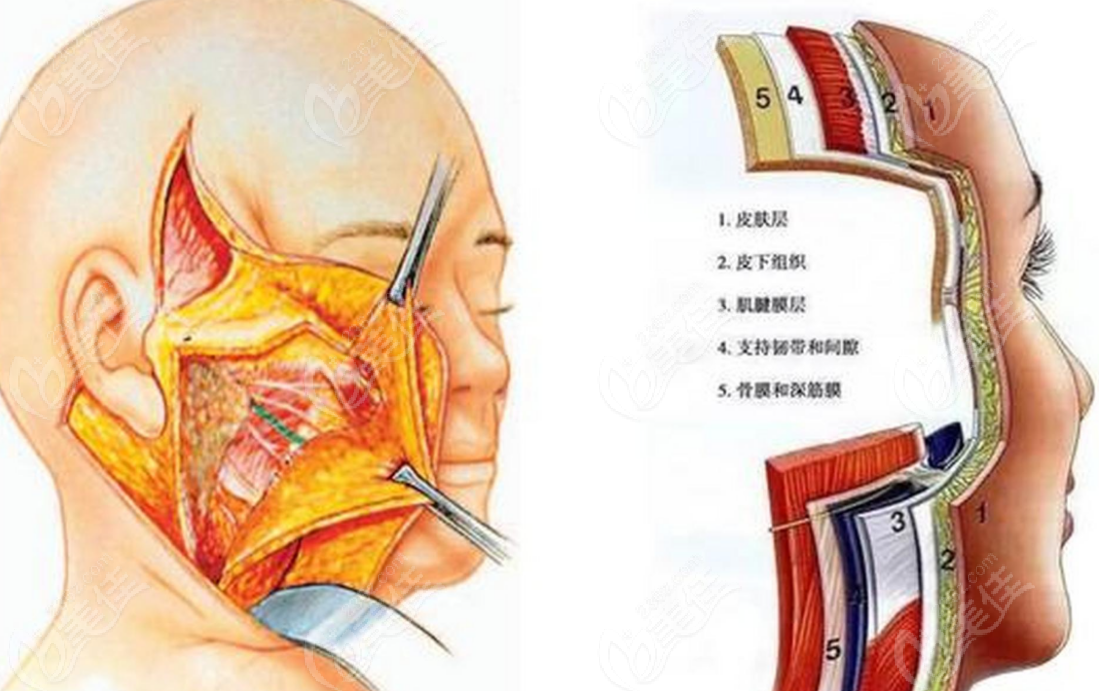 拉皮手术示意图