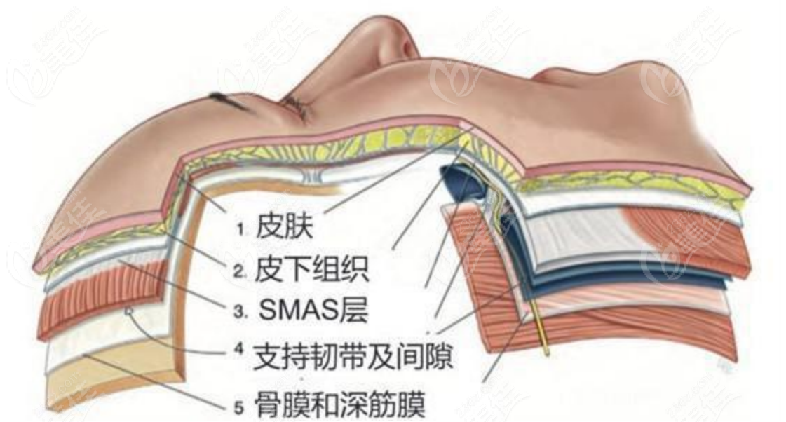 拉皮手术示意图