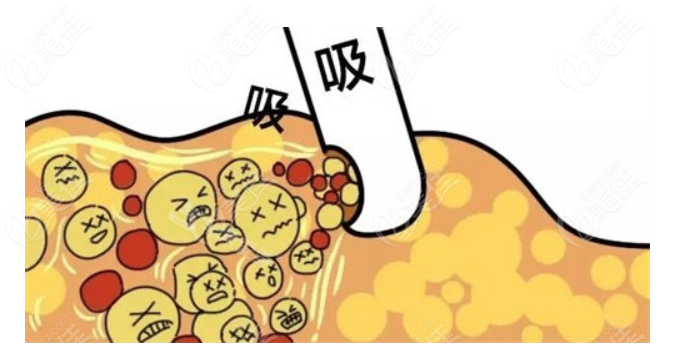 杭州翟爽富贵包吸脂怎么样？好