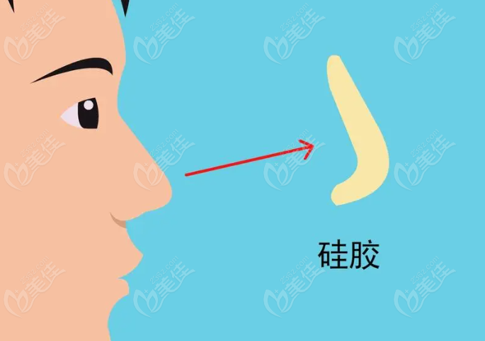 温科磊做鼻子有失败过吗？美佳网