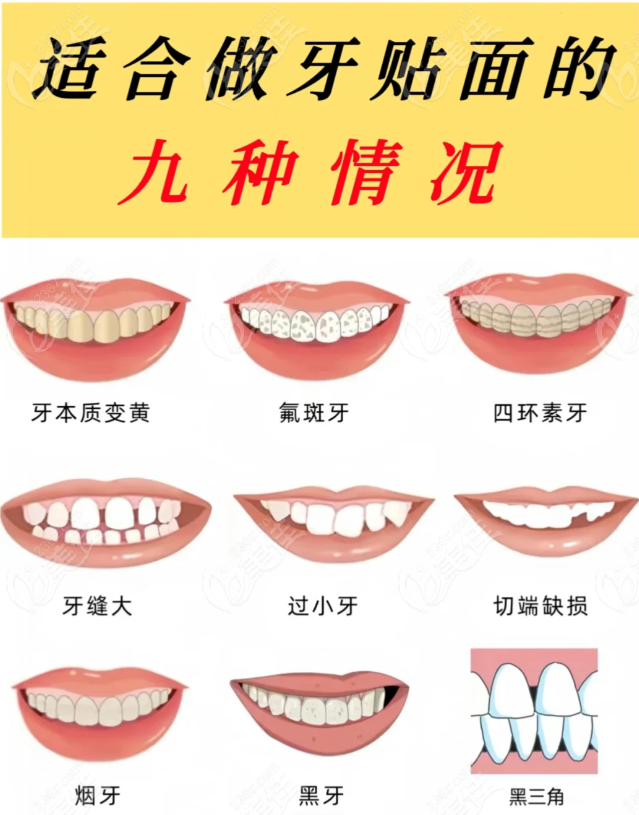 牙缝大做牙贴面