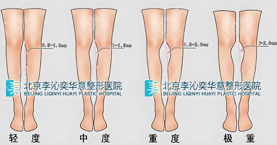 李沁奕矫正o型腿