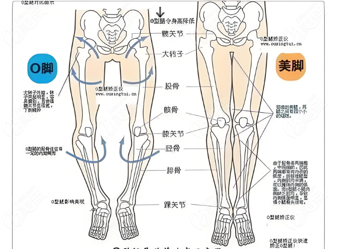 o型腿部结构