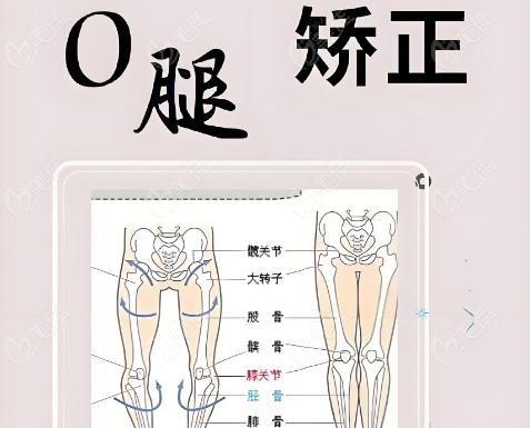 李沁奕腿部矫正手术怎么样www.236z.com