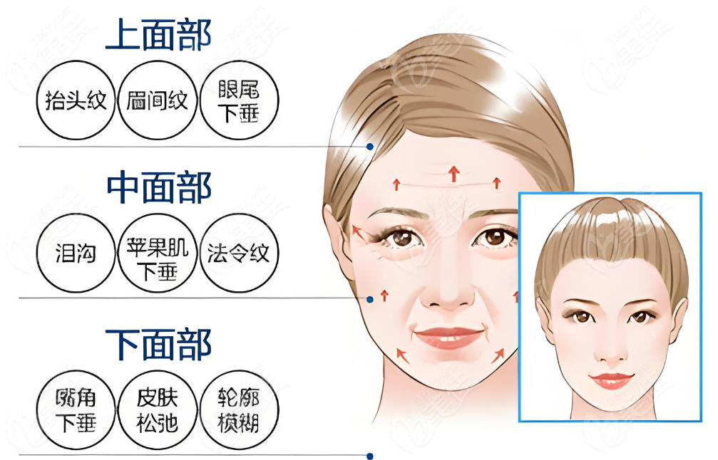 李建钢无痕筋膜提升怎么样