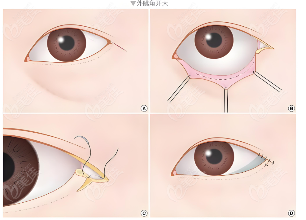 北京美和眼科上眼睑下垂手术技术介绍www.236z.com