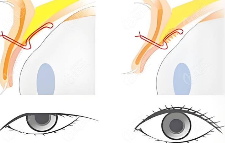 上眼睑下垂矫正手术