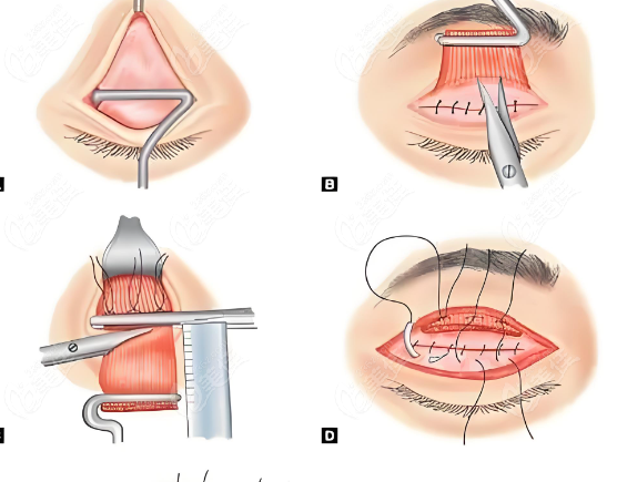 眼皮下垂矫正手术