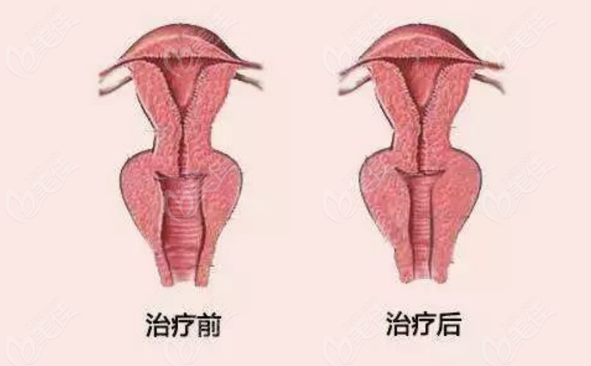 阴道紧缩针诊疗