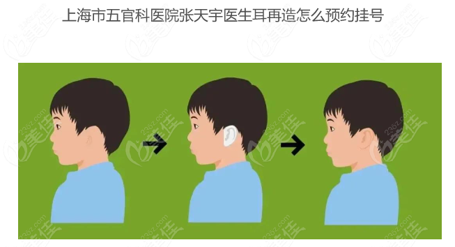 <!--<i data=20240703-sp></i>-->市五官科医院<!--<i data=20240703-sp></i>-->医生耳再造怎么预约挂号