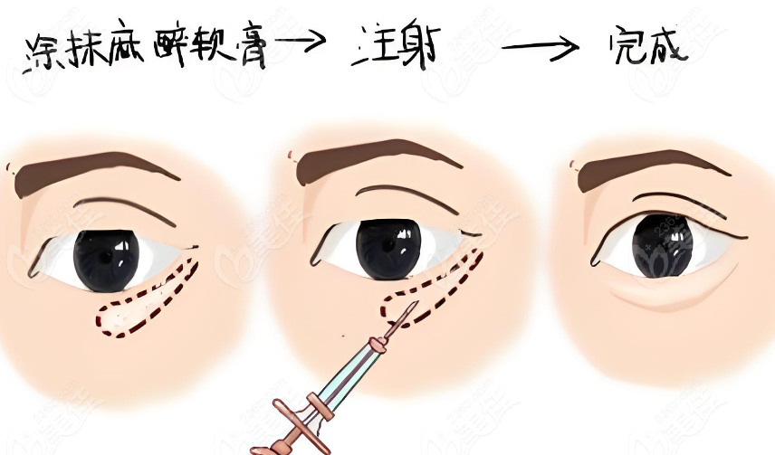 蔣錚錚打臥蠶多少錢？