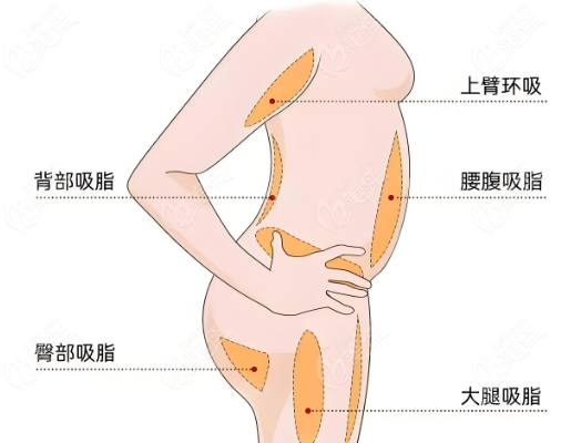 360°全身环吸抽脂手术的部位