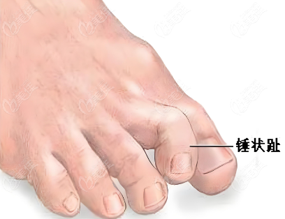 錘狀趾