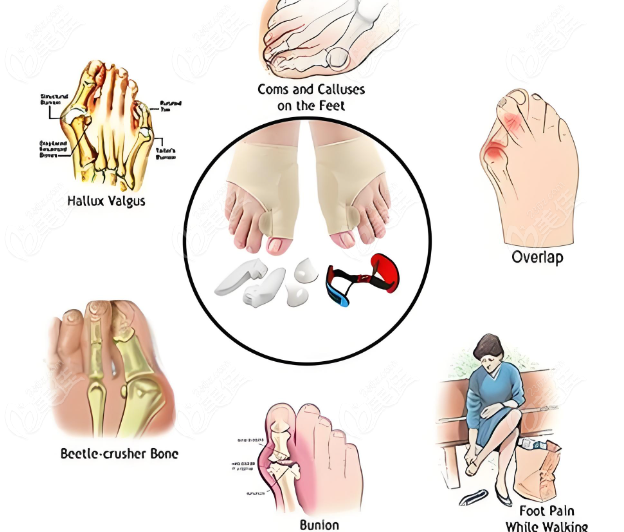 蘇敬達(dá)醫(yī)生大腳骨手術(shù)價格技術(shù)介紹