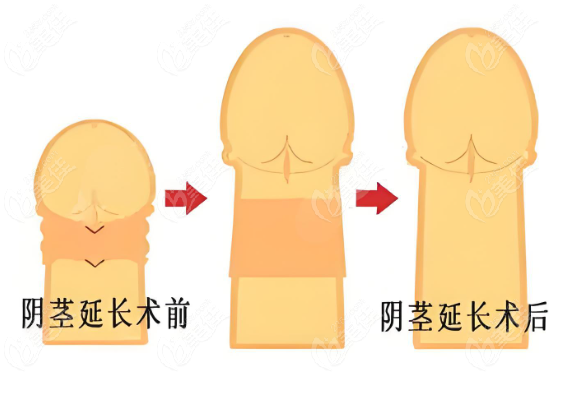 男性微创增长手术对比
