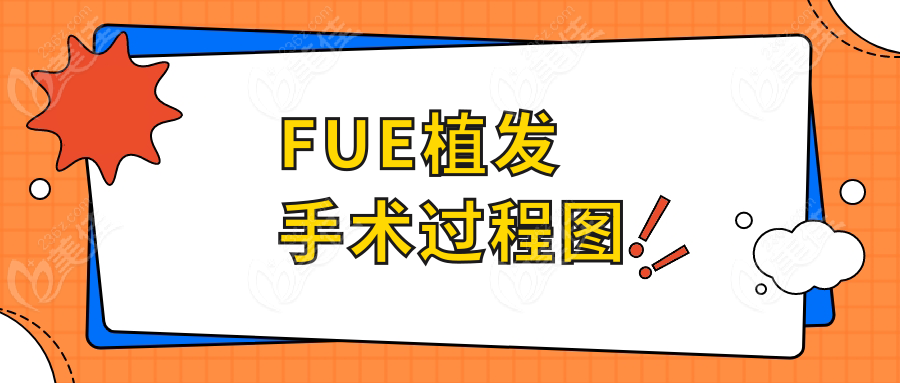 FUE植发手术过程图