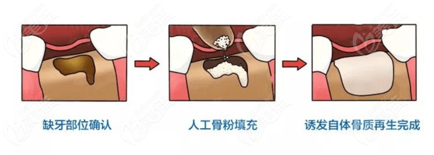 成都英博口腔种植牙技术好价格便宜