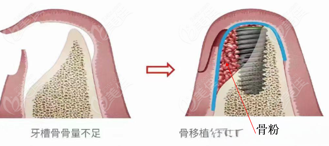 种牙骨粉骨膜