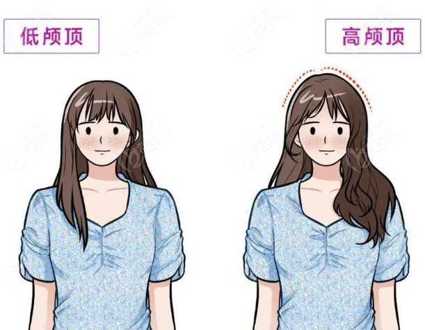 玻尿酸填充高颅顶疗效好