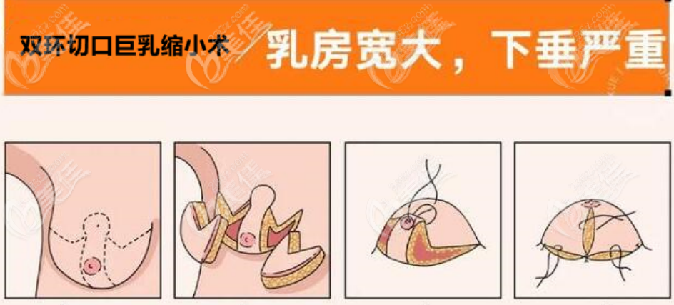 大胸缩小手术