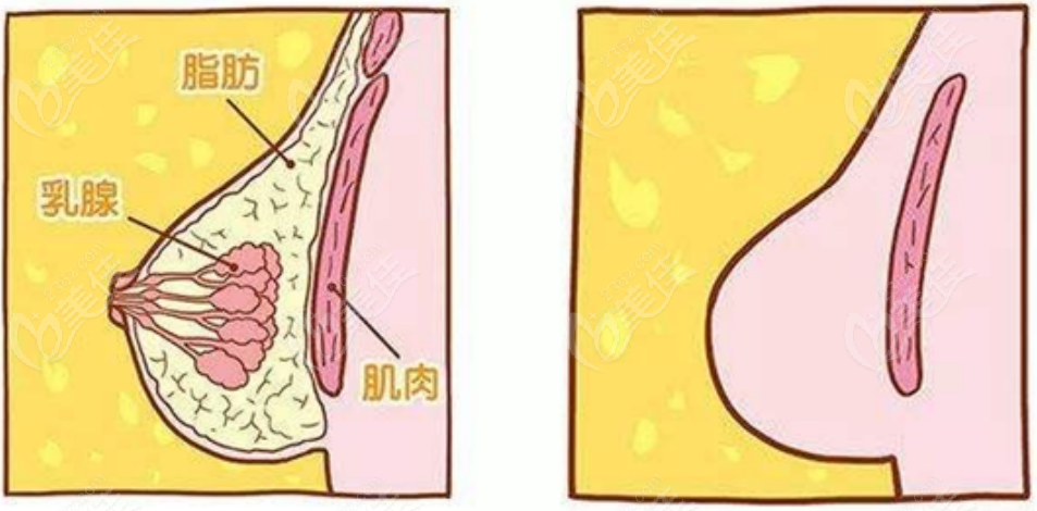 巨乳縮小手術(shù)