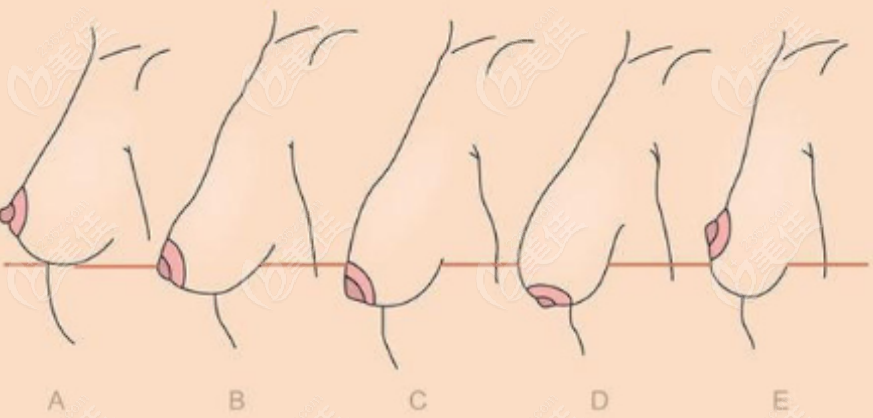巨乳縮小手術(shù)