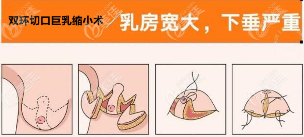 巨乳縮小手術(shù)