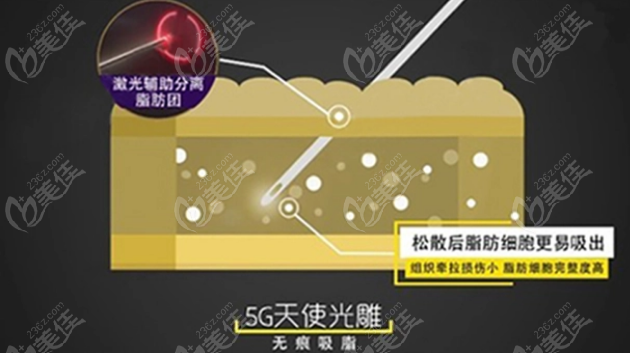 重庆铜雀台5G天使光雕吸脂价格